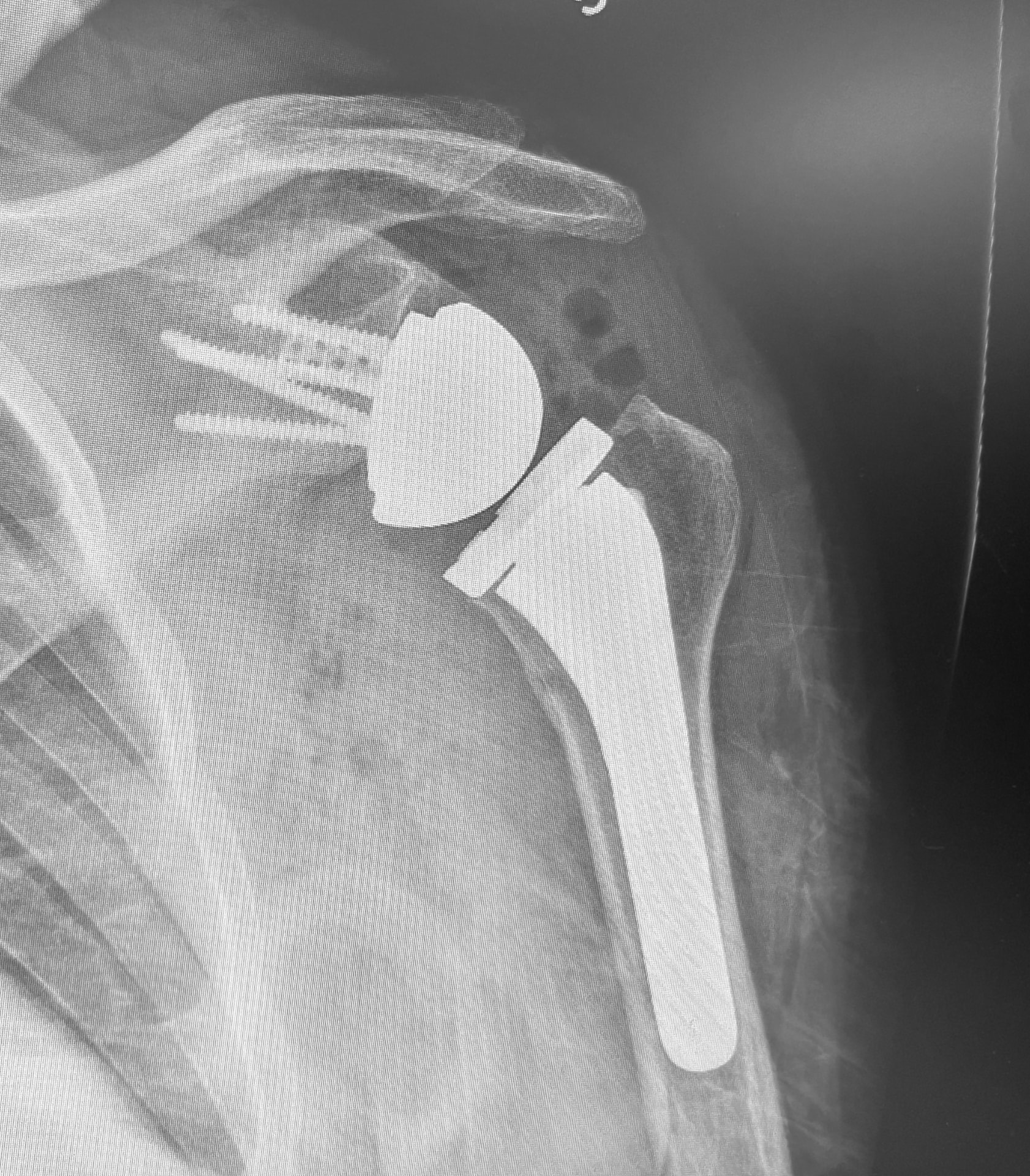 X-ray of a total shoulder replacement showing the metal ball and stem implant